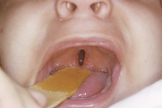 Picture of cleft palate