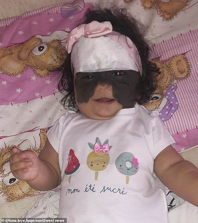 Each surgery costs $25,000 (£19,977) each. Luna had the first one on her forehead