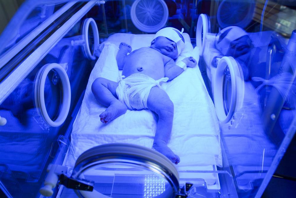 Лечение желтушки у новорожденного с помощью ультрафиолета