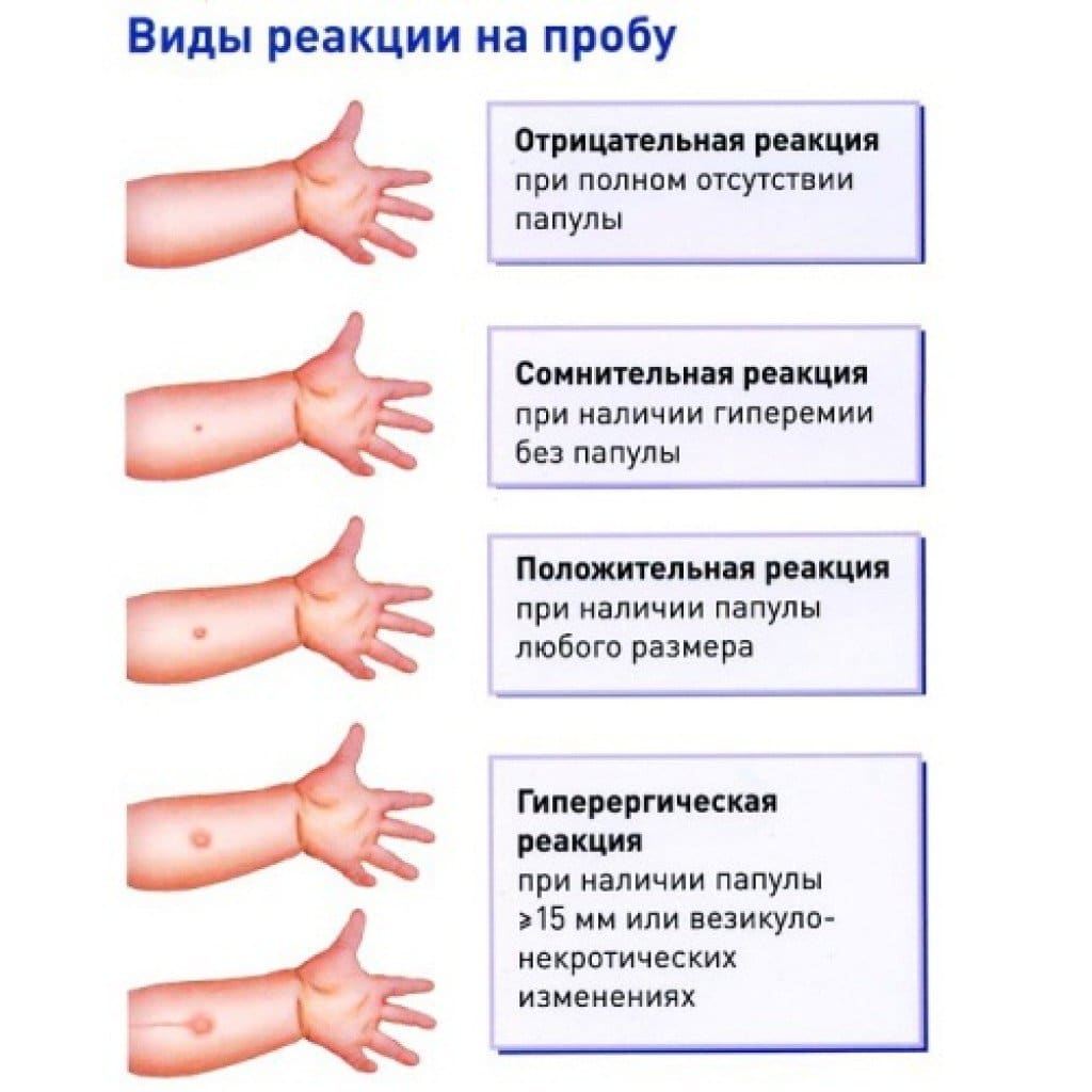 Фото положительной манту у детей