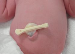 Как обрабатывать пупок новорожденного с прищепкой