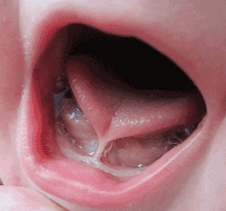 Class IV Tongue tie images: They can extend right to the tip of the tongue. The child will have limited ability to extend their tongue out of their mouth. 