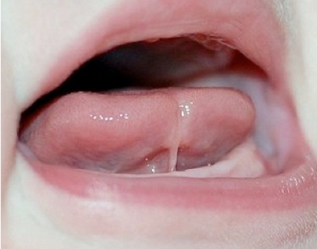Class III tongue tie images: can reach just below the tip of the tongue. 
