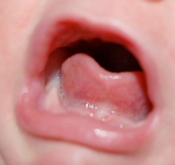 Class I Tongue tie Images: Posterior or submucosal tongue tie. These may be found by running the finger underneath the tongue.